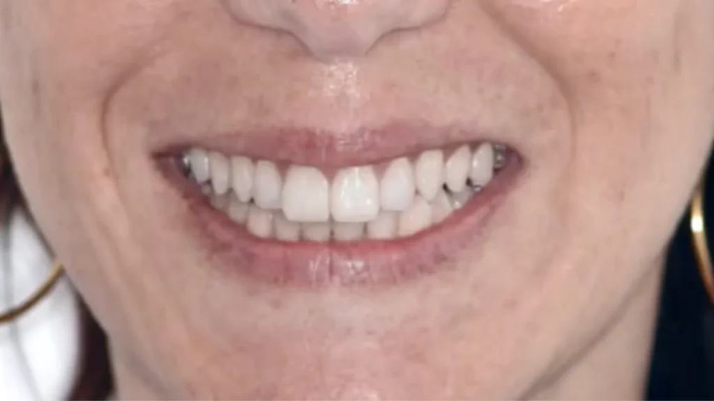 Sorriso al termine del trattamento di faccette dentali ed estetica