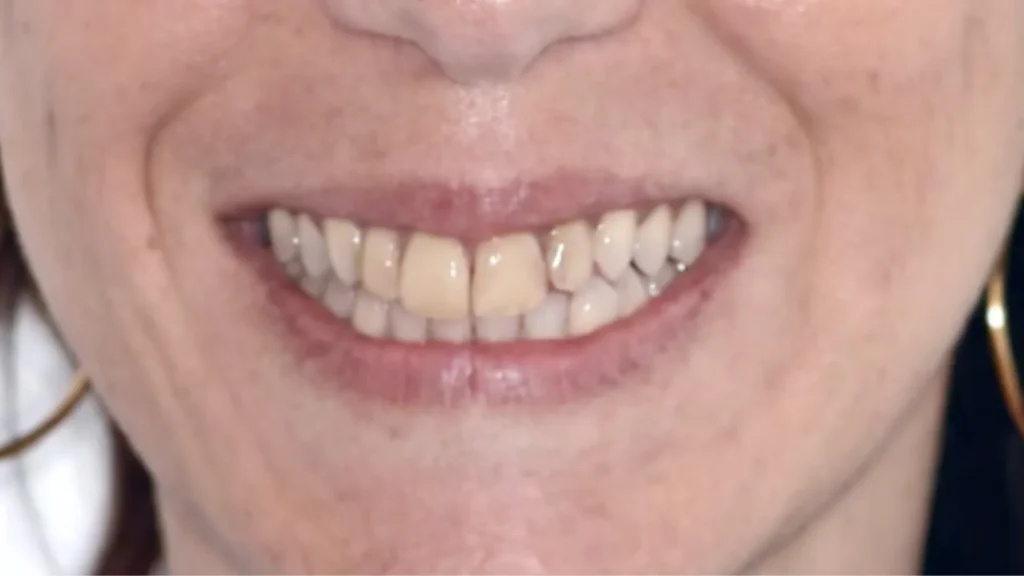 Sorriso prima del trattamento di faccette dentali ed estetica